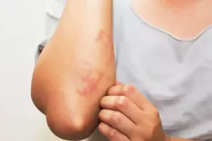 बरेली: त्वचा संबंधी बीमारियों की अनदेखी से कैंसर का खतरा ज्यादा