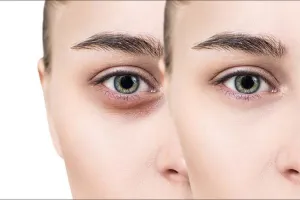 Dark Circles Removal: काले घेरों से छुटकारा पाना है तो अपनाएं यह घरेलू उपाय