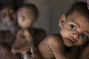 लखीमपुर-खीरी :  बच्चों में टीबी का प्रमुख कारण है कुपोषण