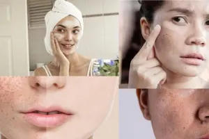 Pigmentation Remedies: स्किन प्रॉब्लम से पाएं आसानी से छुटकारा, अपनाएं यह घरेलू तरीके और पाएं ग्लोइंग फेस