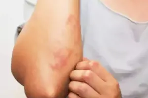 बरेली: गर्मी के प्रकोप ने बढ़ा दिए त्वचा रोगी, करें बचाव