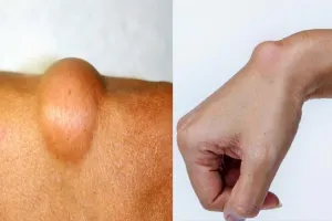 शरीर में चर्बी की गांठ को ना करें नजरअंदाज, निजात पाने के लिए अपनाएं यह घरेलू नुस्खे