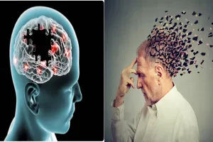 कानपुर: खून की जांच से पता लगेगा अल्जाइमर का खतरा, GSVM मेडिकल कॉलेज और स्वीडन की यूनिवर्सिटी मिलकर करेगी काम