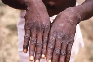 केंद्र सरकार ने मंकीपॉक्स के बढ़ते खतरे के बीच जारी की गाइडलाइन्स, जानिए