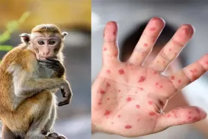 अयोध्या: मंकीपॉक्स वायरस को लेकर स्वास्थ्य विभाग अलर्ट, निगरानी के निर्देश