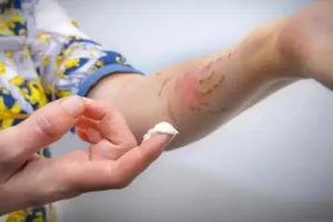 किचन में खाना बनाते वक्त Skin Burn होने पर अपनाएं यह घरेलू नुस्खे, मिलेगी जलन से राहत