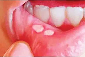 मुंह के छाले और दर्द से हैं परेशान तो अपनाएं यह घरेलू उपाय, जल्द मिलेगी राहत