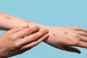 Monkeypox outbreak : मंकीपॉक्स का खतरा और गहराया, स्पेन-ब्राजील में वायरस से पहली मौत दर्ज