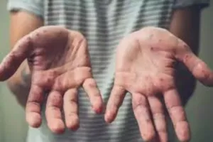 कानपुर : मंकीपॉक्स को लेकर अलर्ट पर स्वास्थ्य विभाग, विदेश से लौटे 117 लोग कराए गए आइसोलेट