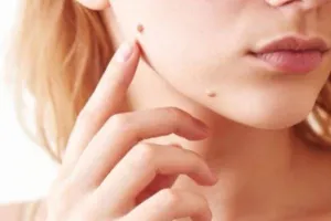 इस तरह हटाएं चेहरे के मस्से, दिखने लगेंगे खूबसूरत