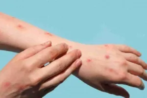 फिलीपींस में मंडराया मंकीपॉक्स का साया, सामने आया पहला मामला