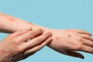 कानपुर: मंकी पॉक्स को लेकर सीएमओ ने जारी की एडवाइजरी, कहा- बरती जाए सतर्कता