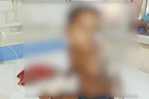 बरेली: खेलते-खेलते गर्म पानी में गिरी तीन साल की बच्ची, हालत नाजुक