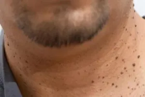 शरीर में किसी भी हिस्से में हो रहे मस्से, तो अपनाएं यह घरेलू उपाय