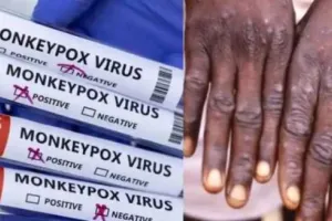 Do’s and Don’ts: अब मंकीपॉक्स से मचा हाहाकार! बचना है तो अभी जान लीजिए इसके बारे में सबकुछ
