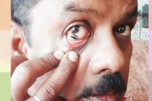 कहीं देखा है देशभक्ति का ऐसा जज्बा! आंख के अंदर बनाया तिरंगा, देखिए तस्वीरें