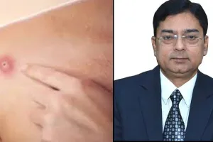 मत भूलो जरूरी प्रोटोकॉल, मंकीपॉक्स के साथ बढ़ रही कोरोना की चाल: डॉ. सूर्यकांत