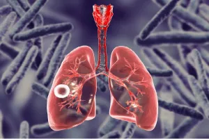 दुनिया में टीबी का हर चौथा रोगी भारतीय : डॉ. सूर्यकान्त