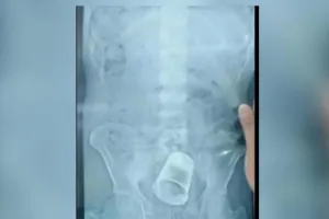 अमानवीय !  ससुरालवालों ने शख्स के प्राइवेट पार्ट में डाला स्टील का गिलास, एक्स-रे की तस्वीर आई सामने