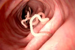 रुद्रपुर: सीएमओ बोले...कृमि रोग को साधारण समस्या न समझें लोग