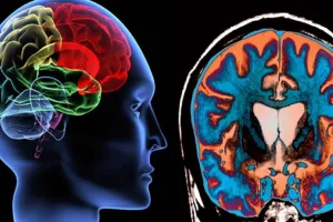 मैकेनिकल थ्रोम्बेक्टोमी से दिमाग का दौरा या लकवा का उपचार हुआ संभव: डॉ अग्रवाल 