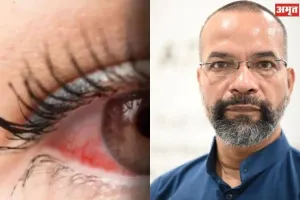 सावधान : आंखों में तेजी से बढ़ रहा संक्रमण, बच्चे और शुगर पीड़ित मरीज रहें सावधान, हो सकती है गंभीर बीमारी