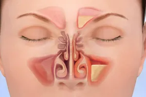 साइनोसाइटिस से हैं परेशान?, अपनी डाइट में करें इन चीजों को शामिल मिलेगा आराम