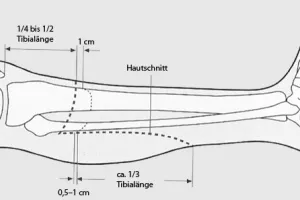 रुद्रपुर: Dial 112 के सिपाही का काटना पड़ा पैर, एम्स ऋषिकेश में है भर्ती