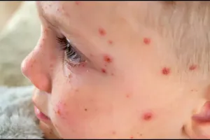 खसरे से मौत के वैश्विक मामलों में 2021-22 के बाद 43 प्रतिशत वृद्धि : WHO