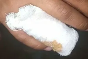 हल्द्वानी: गाना बजाने से रोका, दांत से काट कर अलग की अंगुली