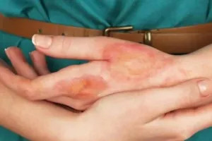 Diwali 2023: पटाखों से जलने पर अपनाएं ये घरेलू नुस्खे, मिलेगी राहत, जल्द भरेंगे घाव