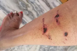 बरेली: सिविल लाइंस में कुत्तों ने महिला को दौड़ाकर काटा, पॉश कालोनी में आतंक से लोग परेशान