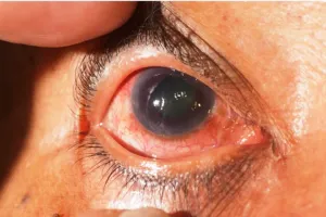 हल्द्वानी: एसटीएच में फिर शुरू होगी काला मोतियाबिंद की जांच