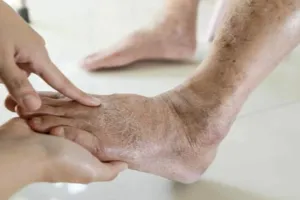 सावधान: 5 साल से शुगर के मरीज हैं तो तुरंत कराएं पैरों और आंखों की जांच, अब इस प्रोटोकटल से होगा इलाज