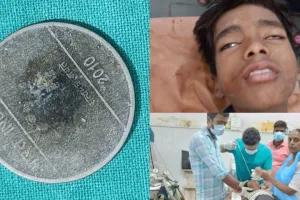 हरदोई के डॉक्टर का कमाल: 7 साल से बच्चे के गले में फँसा था सिक्का, सर्जरी कर निकाला