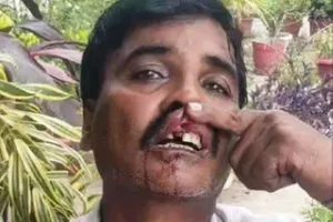 हल्द्वानी: लग्जरी कार के चालक ने तोड़ा रोडवेज बस ड्राइवर का दांत