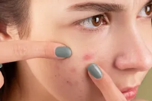 Skincare: बारिश में मुहांसों से परेशान? करें ये टिप्स फॉलो