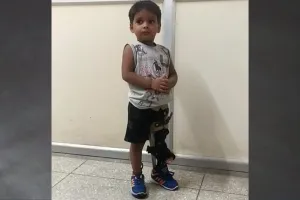 लखनऊ: दिव्यांगता पर ‘अनंत’ की जीत, KGMU के लिंब सेंटर में कृतिम पैर लगाकर उसे दिया चलने का प्रशिक्षण