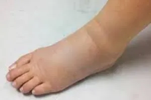 फाइलेरिया से बचाव है जरूरी, 2027 तक फाइलेरिया मुक्त बनाने का लक्ष्य