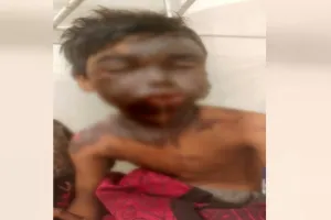 लखीमपुर खीरी: बच्चे की मासूमियत पर हमला! पकौड़ी मांगी तो दुकानदार ने खौलता तेल डाला...बुरी तरह झुलसा