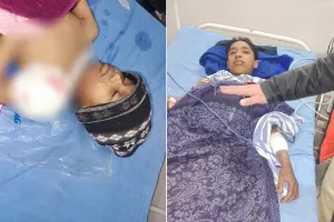 मुरादाबाद: जानवर भगाने को खेत में रखा बम फटा, चपेट में आकर दो बच्चे झुलसे