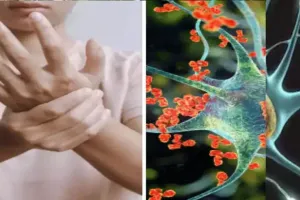 महाराष्ट्र में जीबीएस के 5 नए मामले सामने आए, कुल संख्या 163 पहुंची, जानिए क्या है GBS 