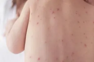 यूरोप में खसरे का सबसे बुरा प्रकोप, WHO ने कहा-उच्च टीकाकरण दरों के बिना कोई स्वास्थ्य सुरक्षा नहीं