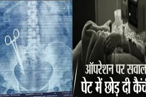 डॉक्टरों की लापरवाही: सर्जरी के बाद महिला के पेट में 17 साल तक पड़ी रही कैंची!