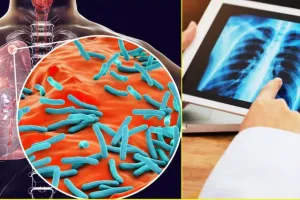 लखीमपुर खीरी: 1608 में फेफड़ों और 2080 लोगों के अन्य अंगों में मिली टीबी, जानिए लक्षण-उपाय 