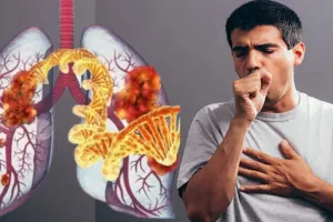 साइलेंट किलर इंटरस्टीशियल लंग डिजीज को न करें नजरअंदाज, जानें कैसे बना रही लोगों को शिकार, SGPGI में विशेषज्ञों ने किया अलर्ट 