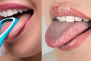 Bareilly: जीभ की सफाई नहीं की तो बढ़ जाएंगी बीमारियां, ऐसे बरतें सावधानी