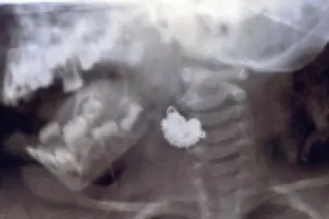 दो साल की बच्ची ने निगला झुमका, डॉक्टरों ने किया सफल ऑपरेशन  