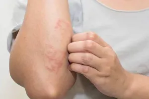 मुरादाबाद : काट रहे कीड़े, लोग हो रहे स्केबीज का शिकार