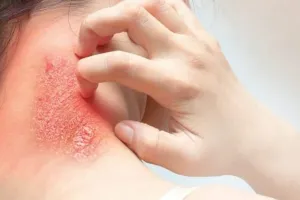 बारिश और उमस से बढ़े फंगल इंफेक्शन के मरीज: इन बातों का रखे खास ख्याल, जानिए बचने के उपाय